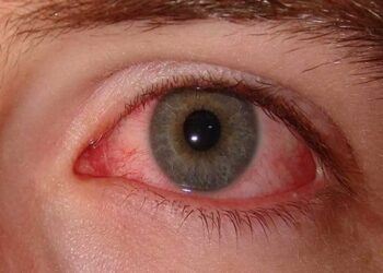 दिल्ली समेत देश के कई हिस्सों आई फ्लू