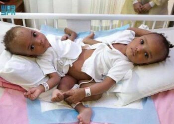 سعودی عرب میں دو جڑی ہوئی بچیوں کا آپریشن کامیاب