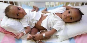سعودی عرب میں دو جڑی ہوئی بچیوں کا آپریشن کامیاب