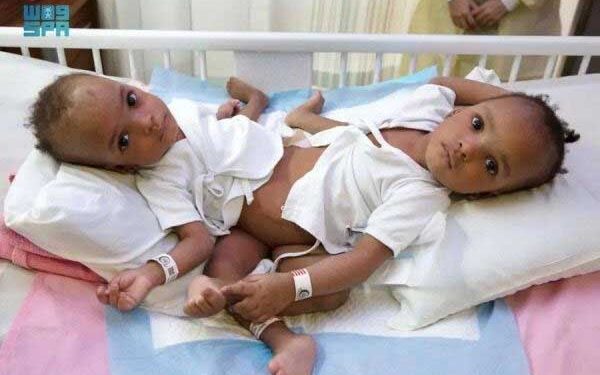 سعودی عرب میں دو جڑی ہوئی بچیوں کا آپریشن کامیاب