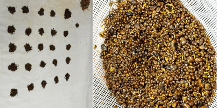 انوکھی سرجری :ایک شخص کے پت سے 6 ہزار سے زائد پتھریاں برآمد