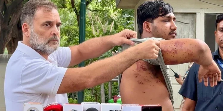 پیپر لیک احتجاج کے دوران زخمی طالب علم کو میڈیا کے سامنے لائے راہل